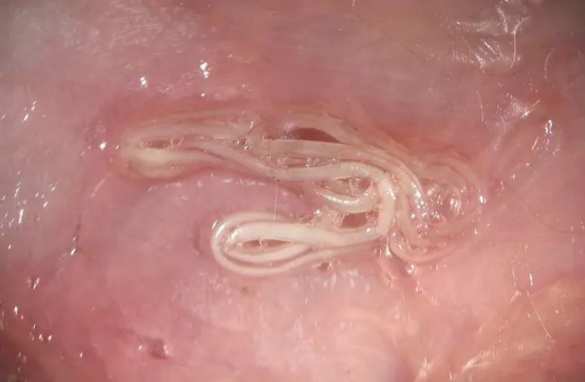 Харьковчанка вытащила из глаза червя длиной почти 13 см (ФОТО 18+) | Русская весна