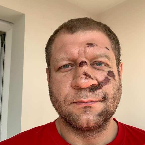 Емельяненко отменил бой после падения с велосипеда (ФОТО) | Русская весна