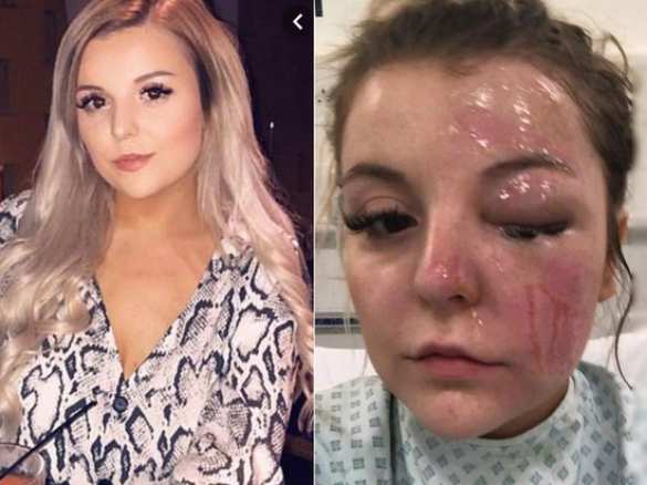 Британка едва не потеряла зрение, сварив яйца по рецепту из Сети (+ФОТО) | Русская весна