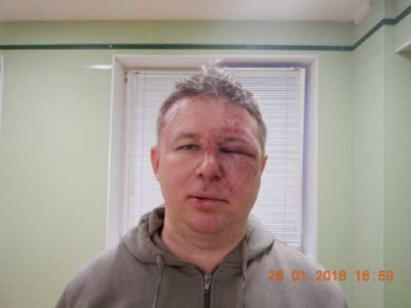 Избит сторонник Навального, обвинённый в мошенничестве людьми Ходорковского (ФОТО) | Русская весна