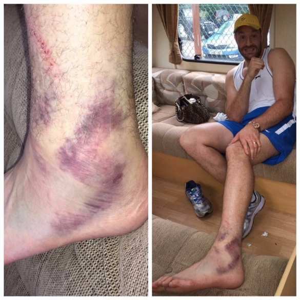 Бой Кличко — Фьюри не состоится (ФОТО) | Русская весна