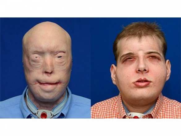 В США проведена сложнейшая операция по пересадке лица (ФОТО + ВИДЕО 18+) | Русская весна