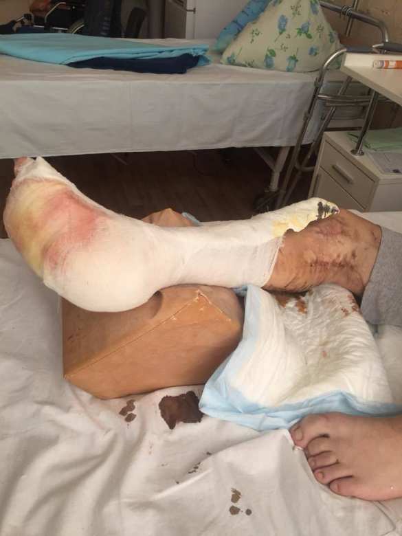 Колонна «скорых»: в Киев доставили раненых карателей (ФОТО 18+) | Русская весна