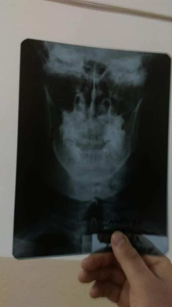 Карателю-«АТОшнику» сломали челюсть за выкрик «Слава Украине» (ФОТО) | Русская весна