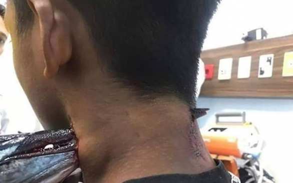 Адская рыбалка: добыча проткнула шею подростка насквозь (ФОТО) | Русская весна