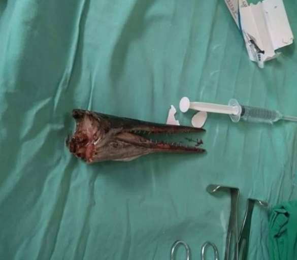 Адская рыбалка: добыча проткнула шею подростка насквозь (ФОТО) | Русская весна