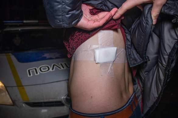 «За лезгинку»: в Киеве парню выстрелили в спину и выбили зуб (ФОТО, ВИДЕО) | Русская весна