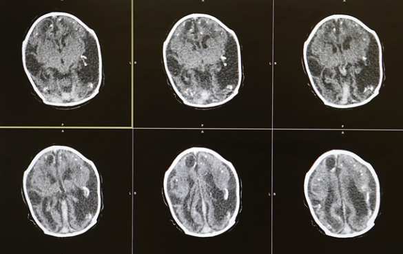 Японские учёные нашли причину шизофрении (ФОТО) | Русская весна