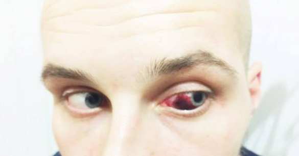 Херсонский политик откусил ухо главе отделения Гражданского корпуса «Азов» (ФОТО+ВИДЕО) | Русская весна