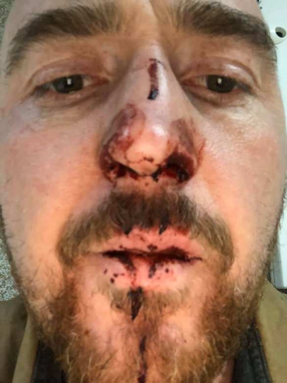 «Сломал нос и душил»: украинского актёра в Польше жестоко избил работодатель (ФОТО) | Русская весна