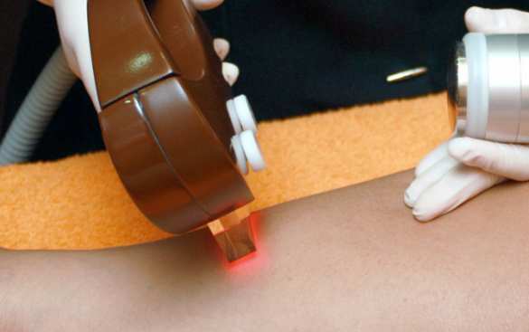 Лазерная эпиляция: мифы и реальные возможности современных аппаратов | Русская весна