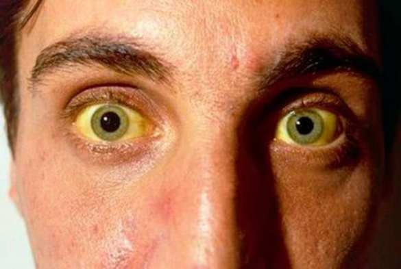 В США — крупнейшая вспышка гепатита | Русская весна