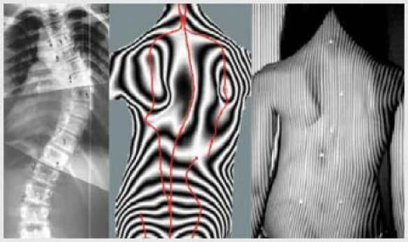 В России внедрят инновационную новосибирскую систему диагностики сколиоза у детей | Русская весна