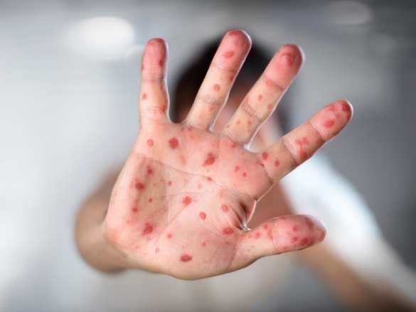 Просвещенная Европа: россиян предупредили о вспышке кори в ЕС и на Украине | Русская весна